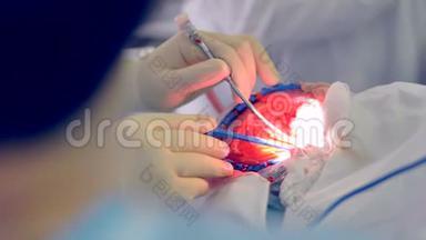 手在外科手套中使用消毒设备进行手术。 4K.